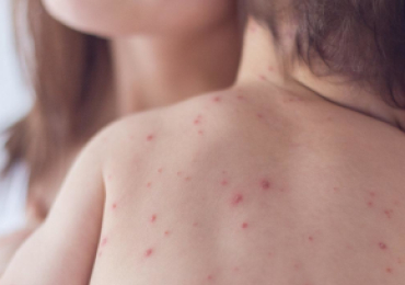 Гнойничковые поражения кожи у детей