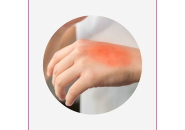 Что нам нужно знать если вдруг на природе разведя костер мы получили ожог?