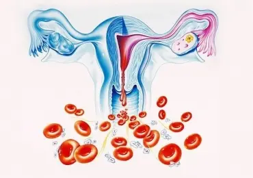 Аномальное маточное кровотечение