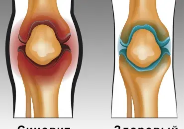 Синовит коленного сустава