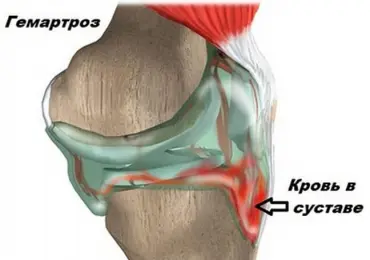 Гемартроз коленного сустава