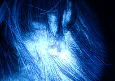 Обследование лампой Вуда в Красноярске: точная диагностика кожи