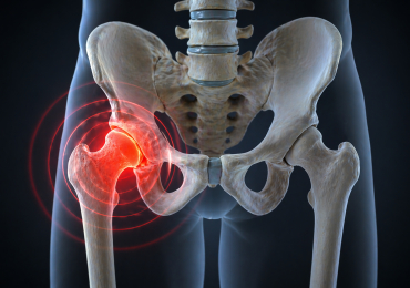 Коксартроз