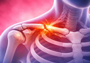 Перелом ключицы