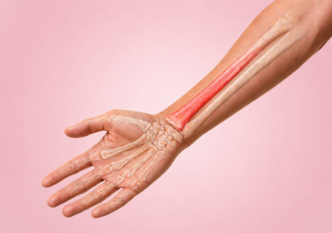 Перелом лучевой кости