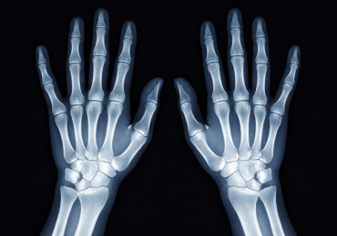 Синдром Зудека