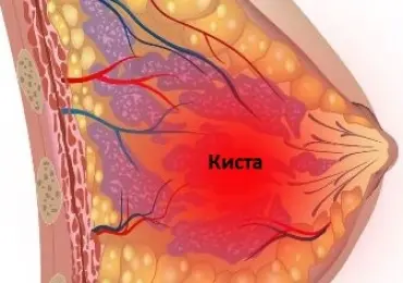 Кисты молочной железы на УЗИ