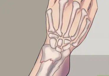 Переломы запястья у детей