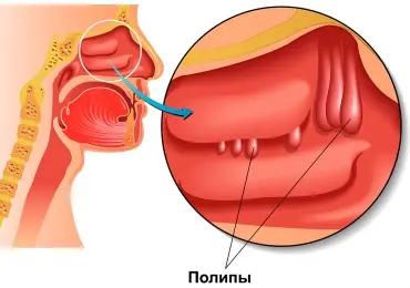 Полипы в носу