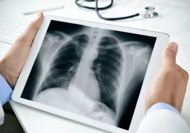 Когда необходимо делать рентген легких?