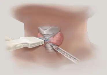 Пункция узлов щитовидной железы