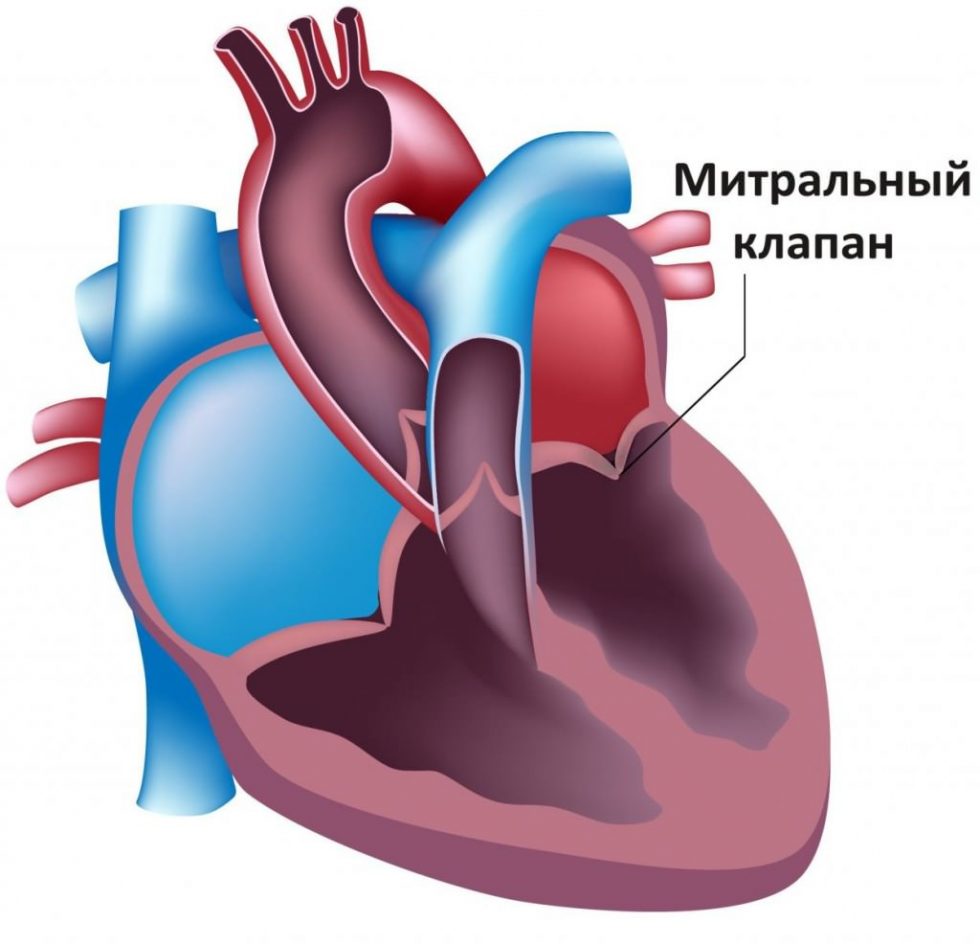 Осложнения недостаточности митрального клапана