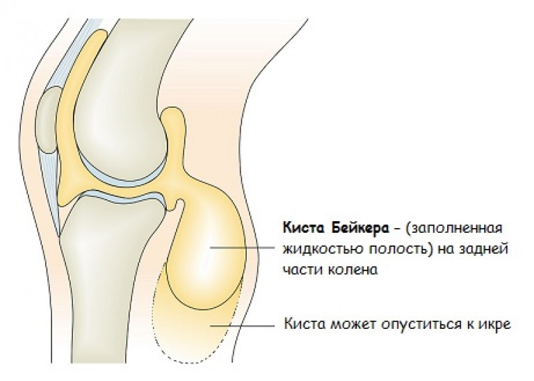Лечение. Коленный сустав. Киста Бейкера блог компании | Новый шаг