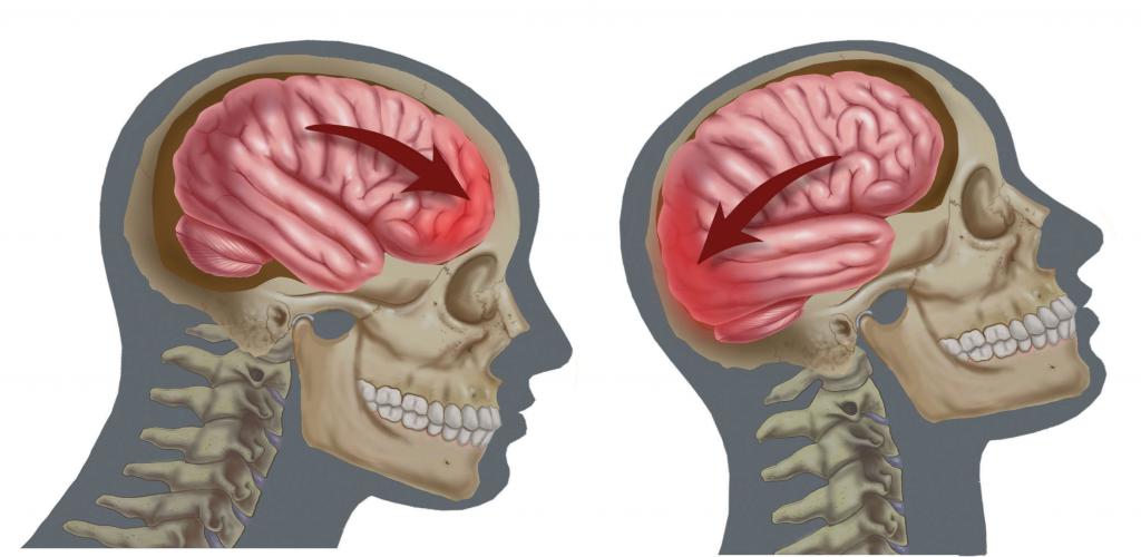 Последствия сотрясений мозга