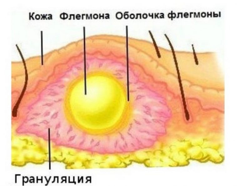 Абсцесс мягких тканей – признаки, диагностика, осложнения и методы лечения в «СМ-Клиника»