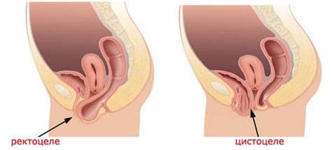 Восстановление вагинальных тканей после родов без операции.