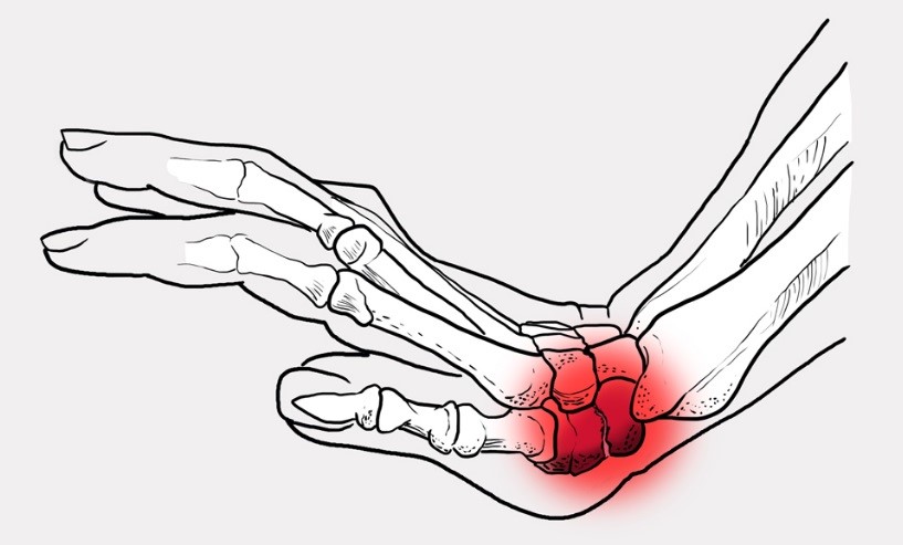 Лечение перелома кисти руки