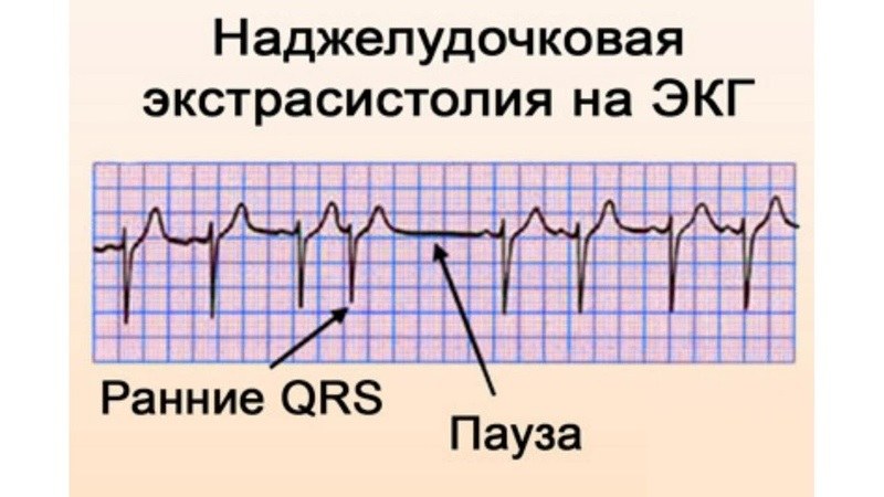 Обозначение зубцов экг p q r s t ввел