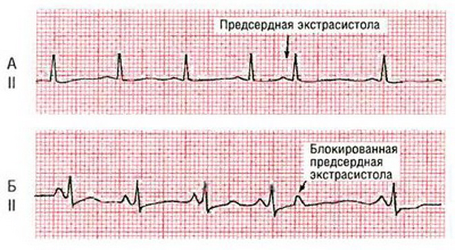 Предсердная экстрасистолия на экг фото